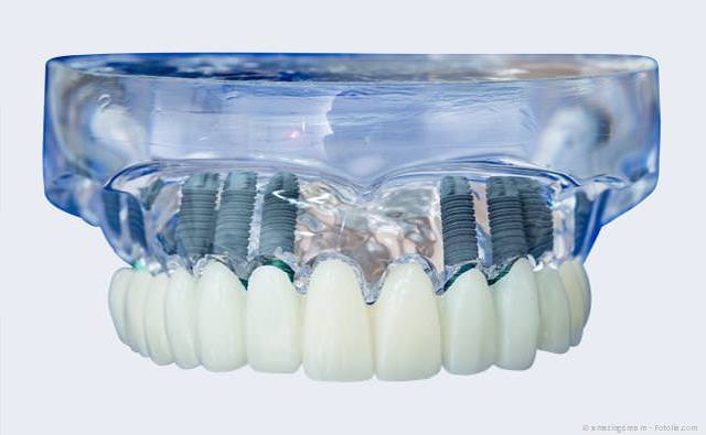 Feste Zähne auf Implantaten